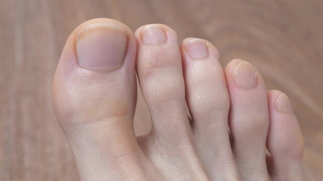 Male foot with uncut nails, close-up shot video. Foot and toes of an adult man. Man wiggles his toes

