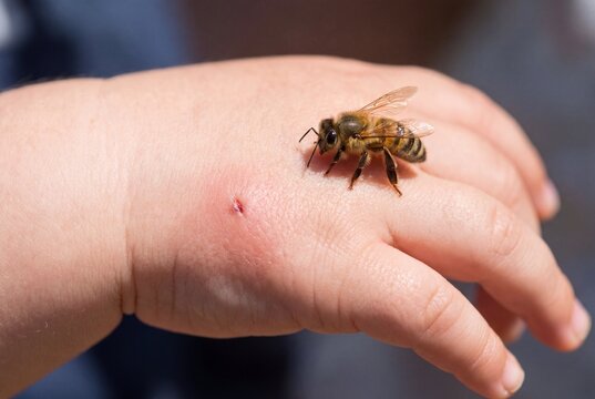 Macro close-up of a honey bee sitting on a baby's hand next to a red sting mark. Insect bite, skin allergy, and childhood danger concept