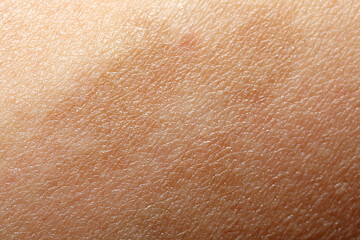 Fototapeta premium Macro view of skin with birthmark as background