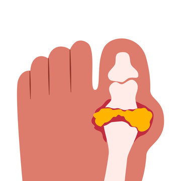 Gout illness and uric acid crystals joint inflammation vector Illustration. Acute gout arthritis attack in toe joint. Swollen foot joint