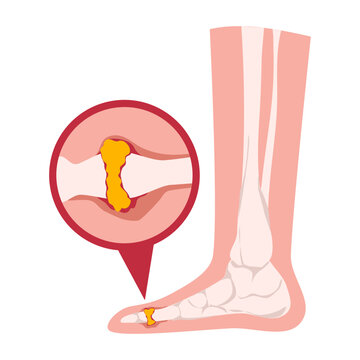 Gout illness and uric acid crystals joint inflammation vector Illustration. Acute gout arthritis attack in toe joint. Swollen foot joint