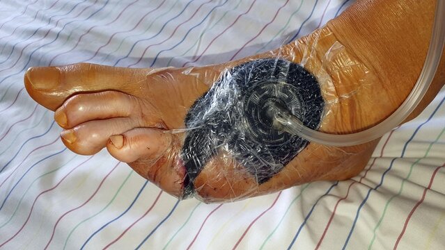 Vacuum therapy after surgery for diabetic foot syndrome, Hospital, Peine, Lower Saxony, Germany