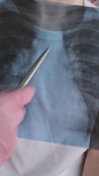 Doctor shows chest x-ray and highlights important areas with a tool in a medical clinic
