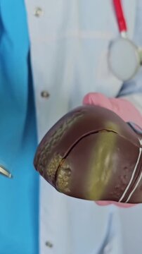 Doctor with human liver anatomy model. Liver cancer and tumor