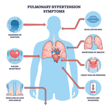 Pulmonary hypertension symptoms diagram shows lungs, heart, and human figure, highlighting breathlessness, chest pain, and fatigue for fast understanding. Outline diagram