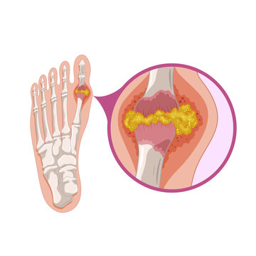 Gout Arthritis Anatomical Illustration of Foot Joint Inflammation with Uric Acid Crystals