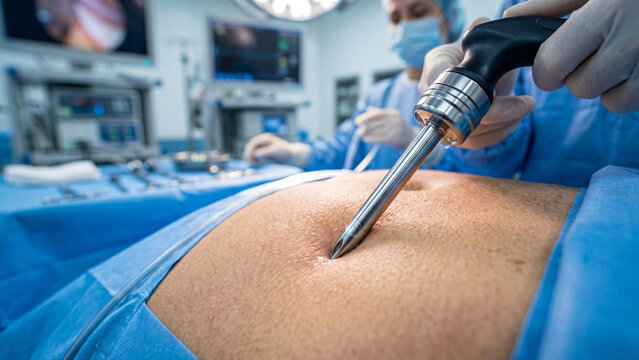 Close-Up of Laparoscopic Trocar Insertion During Abdominal Surgery