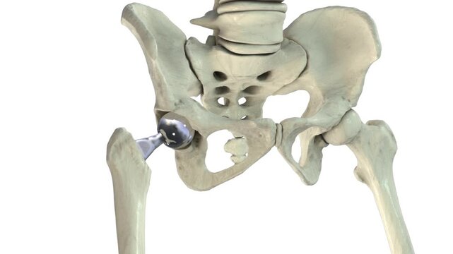 Unipolar hip prosthesis implanted in the proximal femur, rotating 3D animation showing hemiarthroplasty configuration. Orthopedic visualization of femoral head replacement.