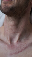 Fototapeta premium Man showing healing scar on neck and chest