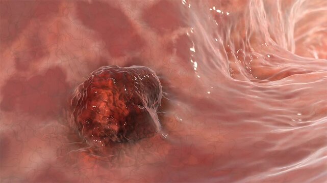 Colorectal tumor arising from the wall of the large intestine, rotating 3D animation showing intraluminal mass and bowel anatomy. Medical visualization of colorectal cancer.