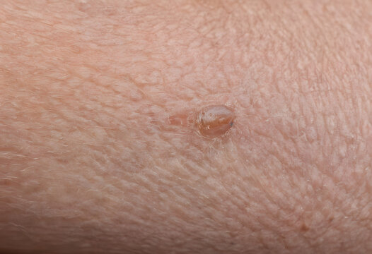 Human skin examining a small blister or nevus