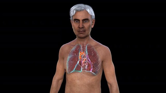 Pulmonary lymphadenitis visualised within transparent thoracic anatomy of adult male body, enlarged inflamed lymph nodes highlighted in rotating 3D medical animation.
