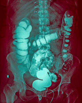 Barium enema X-ray showing a colon polyp in the descending colon, medical imaging of colorectal neoplasm