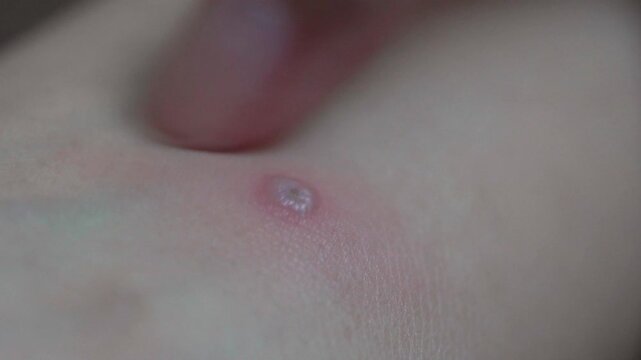Close up of a chickenpox blister on human skin with red rash