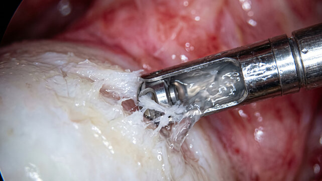 Extreme Macro of Arthroscopic Bone Shaver Debriding Cartilage Tissue