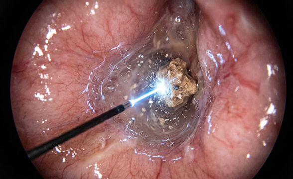 Endoscopic View of Laser Lithotripsy Shattering Kidney Stone in Fluid