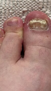 Toenail fungal infection closeup showing yellowed crumbling big toenail and surrounding toes on white carpet