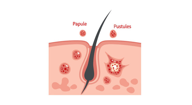 Skin anatomy diagram illustration showing papule and pustule inflammation around a hair follicle for dermatology