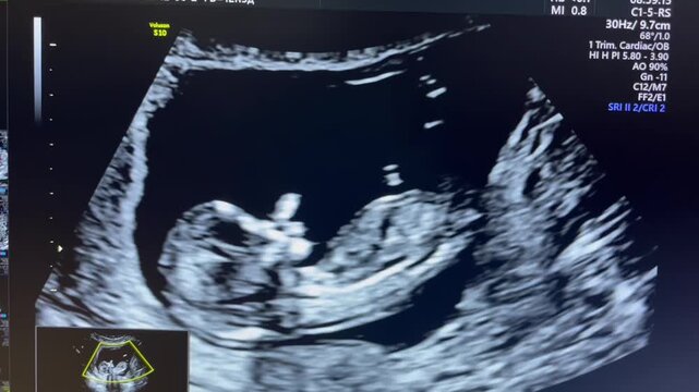Ultrasound images depict the continuous development of a fetus in the first trimester, showcasing anatomical features and the gradual progression of the fetus within the womb