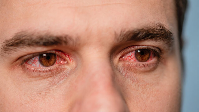 Keratitis is a common inflammatory eye disease that affects the cornea, often causing redness, soreness, blurred vision and eye irritation. Caused by bacterial, viral or fungal infections and external