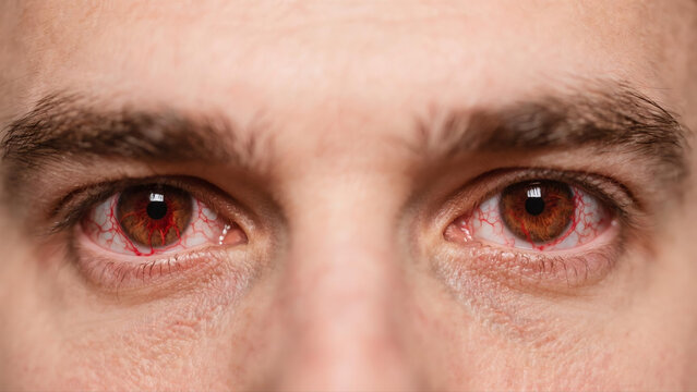 Keratitis is a common inflammatory eye disease that affects the cornea, often causing redness, soreness, blurred vision and eye irritation. Caused by bacterial, viral or fungal infections and external
