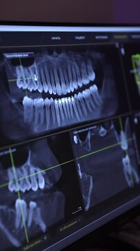 Surgeon Assesses Back Tooth Region. Clinician Uses Imaging Tools To Evaluate Posterior Molars Carefully