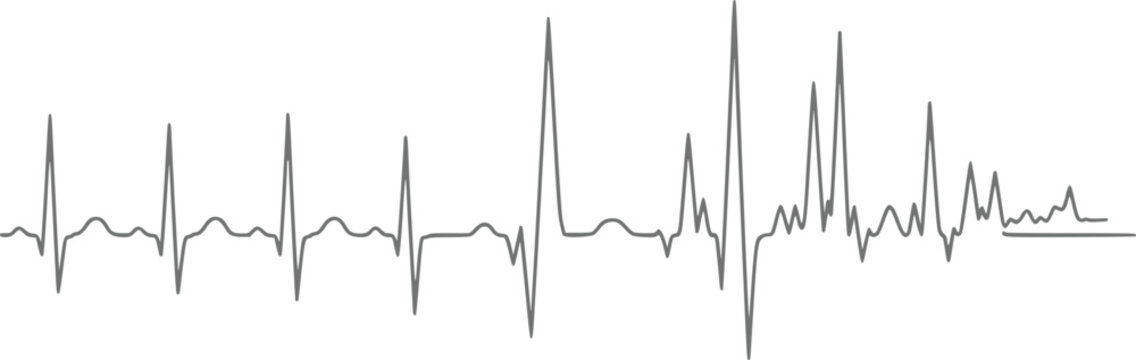 A digital representation of an irregular human heartbeat shown as a clinical electrocardiogram line graph trace