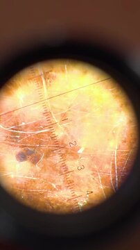Oncology clinic. Warts on human skin. Skin cancer screening. Papillomas on human skin - Vertical video