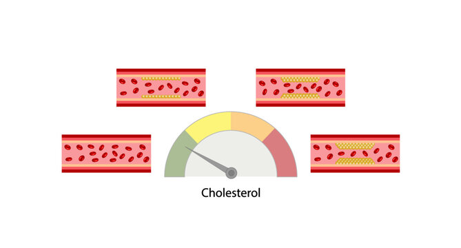 Hyperlipidemia, Atherosclerosis. cholesterol chart on white background. High cholesterol level as atherosclerotic risk. ldl and hdl. Vector design.