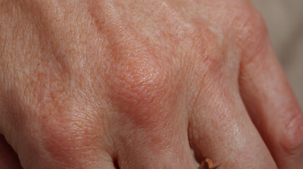 Fototapeta premium Close-up view of an adult hand affected by a skin condition with visible swelling and redness, highlighting complex epidermal details on healthy skin