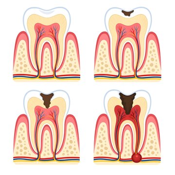 Dental Caries Progression Stages Illustration.