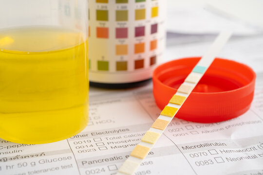 Urinalysis, urine cup with reagent strip pH paper test and comparison chart in laboratory.