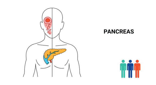 Medical diagram showing the location of the pancreas in the human torso alongside small figures representing demographic health data.