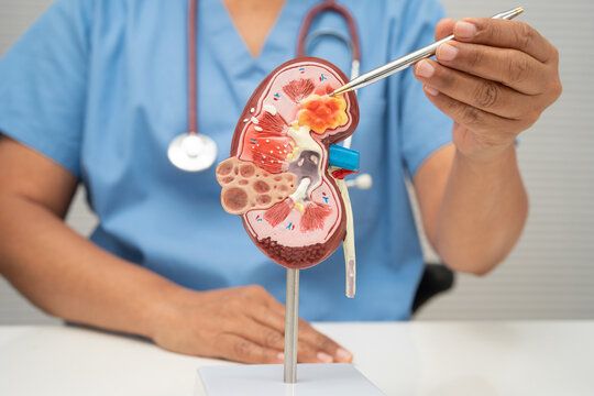 Chronic kidney disease, doctor with model for treatment urinary system, urology, Estimated glomerular filtration rate eGFR.
