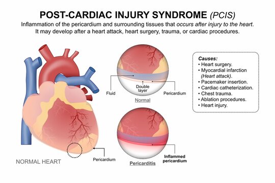 Post-Cardiac Injury Syndrome (PCIS)