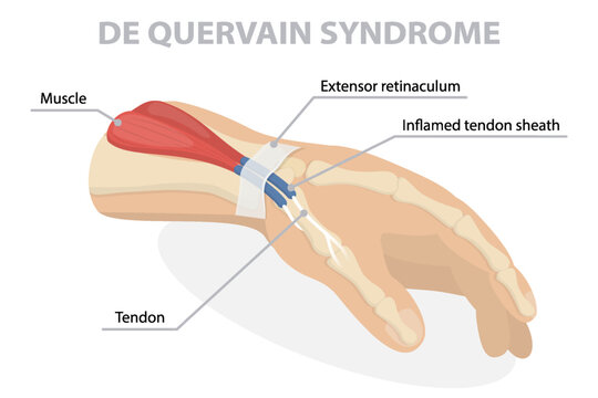 De Quervain syndrome poster. Labeled occupational disease of the hand diagram. Chronic health problem. 3d vector flat isometric illustration isolated on white background.