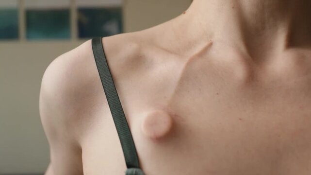 detailed close view of an implanted chemo port and small scar on the upper chest with a hand nearby, highlighting medical access, tenderness and body awareness after therapy