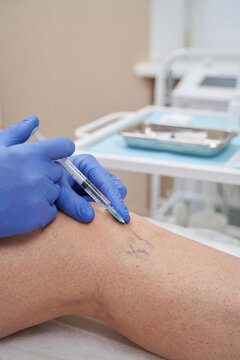 A close-up of a medical professional gloved hands performing a sclerosant injection into a leg vein. The varicose veins treatment, medical intervention, health and specialized cosmetic procedures