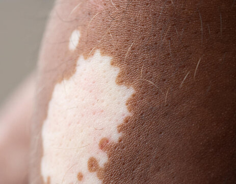 Close-up of Human Skin Showing Vitiligo Patches and Pigmentation Differences.
