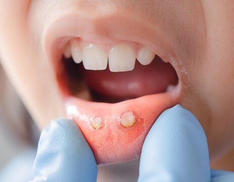 Close-up of Mouth with Canker Sores and Medical Examination.
