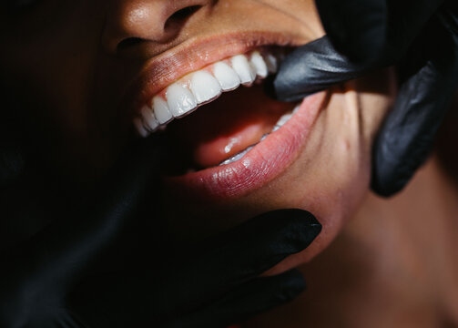 Close up de la sonrisa siendo analizada por dentista 