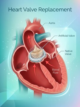 A medical illustration of a human heart with an artificial valve replacement.