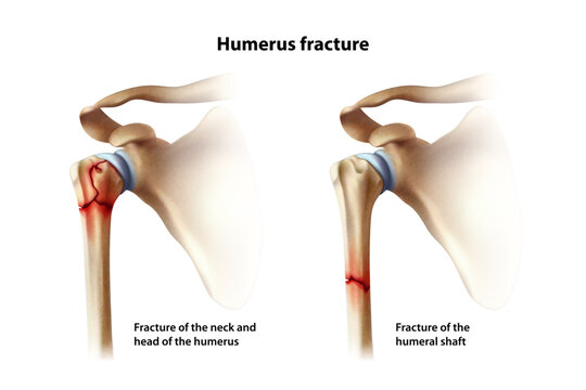 Fracture humerus. Isolated vector illustration