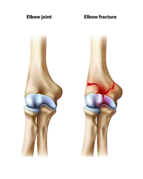 Elbow injury. Isolated vector illustration