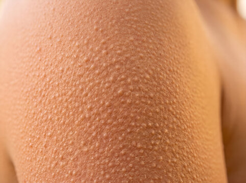 Intimate close-up of human skin presenting a distinctive texture of numerous small, raised bumps, emblematic of piloerection or goosebumps, a natural bodily reaction to cold or emotional stimuli