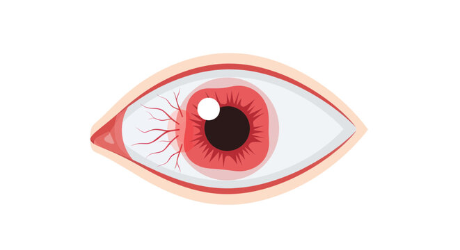 Red, Irritated Eye with Bloodshot Sclera and Dilated Pupil