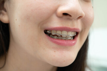Naklejka premium Asian woman wearing Hawley retainer removable orthodontic appliance maintain position of teeth.