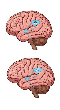 Human brain anatomy with highlighted Brocas area regions.