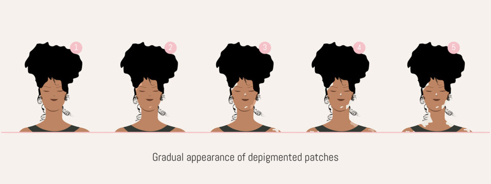 Vitiligo progression stages in woman portrait flat vector illustration