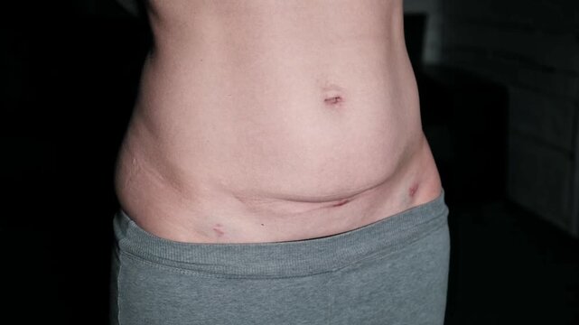 Fresh medical scars on female abdomen after laparoscopic surgery. Stretch marks on light caucasian skin after cesarean section on dark background. Body Lymphatic edema. Maternity concept. Front view.